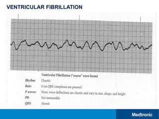 Vi Fib ECG & Intro to Cardiac Arrhythmias.pptx