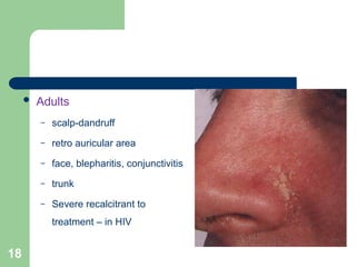 Entrectinib Preauricular Rash Pharmacotherapy of Atopic dermatitis (Eczema)_pharmD.ppt