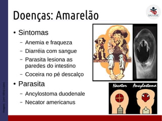 Doenças: Amarelão
● Sintomas
– Anemia e fraqueza
– Diarréia com sangue
– Parasita lesiona as
paredes do intestino
– Coceira no pé descalço
● Parasita
– Ancylostoma duodenale
– Necator americanus
Imagem:LivroSôniaLopes
 