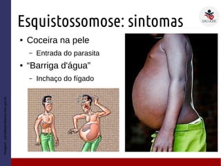 Esquistossomose: sintomas
● Coceira na pele
– Entrada do parasita
● “Barriga d'água”
– Inchaço do fígado
Imagem:portaldoprofessor.mec.gov.br
 