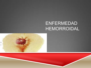ENFERMEDAD
HEMORROIDAL
 