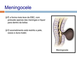 Meningocele
 É a forma mais leve da EBC, com
protusão apenas das meninges e líquor
para dentro da bolsa:
 O acometimento está restrito a pele,
ossos e dura-matér;
 