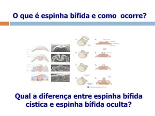 O que é espinha bífida e como ocorre?
Qual a diferença entre espinha bífida
cística e espinha bífida oculta?
 