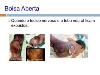 Bolsa Aberta
 Quando o tecido nervoso e o tubo neural ficam
expostos.
 