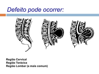 Defeito pode ocorrer:
Região Cervical
Região Torácica
Região Lombar (a mais comum)
 