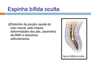 Espinha bífida oculta
Distúrbio da porção caudal do
tubo neural, pele intacta,
deformidades dos pés, assimetria
de MMII e distúrbios
esfincterianos.
 