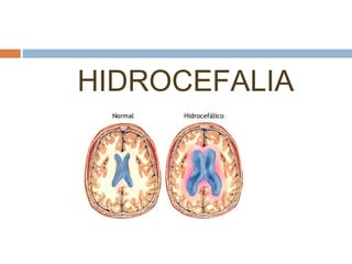HIDROCEFALIA
 
