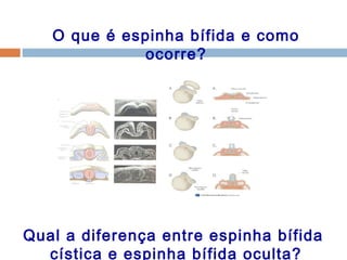 O que é espinha bífida e como
ocorre?
Qual a diferença entre espinha bífida
cística e espinha bífida oculta?
 
