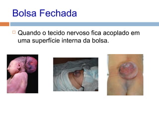 Bolsa Fechada
 Quando o tecido nervoso fica acoplado em
uma superfície interna da bolsa.
 