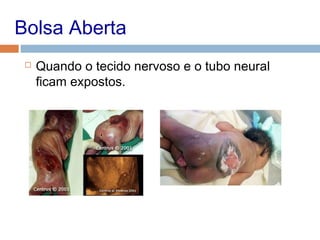 Bolsa Aberta
 Quando o tecido nervoso e o tubo neural
ficam expostos.
 