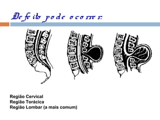 De fe ito po de o co rre r:
Região Cervical
Região Torácica
Região Lombar (a mais comum)
 