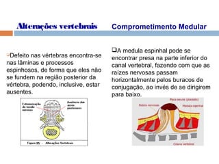 Alterações vertebrais
Defeito nas vértebras encontra-se
nas lâminas e processos
espinhosos, de forma que eles não
se fundem na região posterior da
vértebra, podendo, inclusive, estar
ausentes.
Comprometimento Medular
A medula espinhal pode se
encontrar presa na parte inferior do
canal vertebral, fazendo com que as
raízes nervosas passam
horizontalmente pelos buracos de
conjugação, ao invés de se dirigirem
para baixo.
 