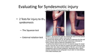Evaluating for Syndesmotic injury
e
• 2 Tests for injury to th
syndesmosis
– The Squeeze test
– External rotation test
 