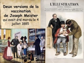 Deux versions de la 
vaccination 
de Joseph Meister 
qui avait été mordu le 4 
juillet 1885 
 