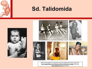Sd. Talidomida
 