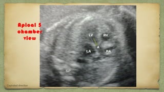 Apical 5
chamber
view
Cephalad direction
 
