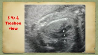 3 Vs &
Trachea
view
 