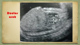 Ductus
arch
 