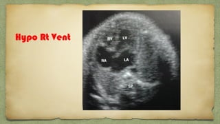 Hypo Rt Vent
 