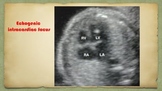 Echogenic
intracardiac focus
 