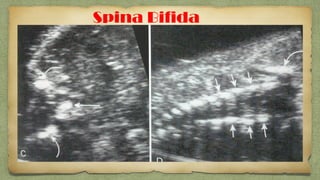 Spina Bifida
 