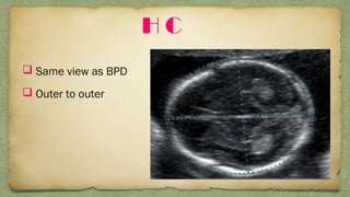 H C
 Same view as BPD
 Outer to outer
 