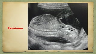 Teratoma
 