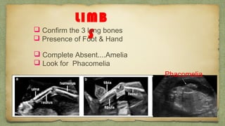 LIMB
S Confirm the 3 long bones
 Presence of Foot & Hand
 Complete Absent....Amelia
 Look for Phacomelia
Phacomelia
 