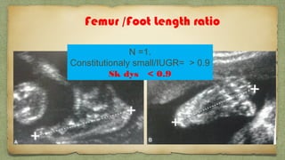Femur /Foot Length ratio
N =1.
Constitutionaly small/IUGR= > 0.9
Sk dys < 0.9
 
