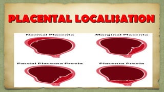 PLACENTAL LOCALISATIONPLACENTAL LOCALISATION
 