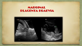 MARGINALMARGINAL
PLACENTA PRAEVIAPLACENTA PRAEVIA
 
