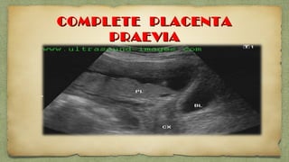 COMPLETE PLACENTACOMPLETE PLACENTA
PRAEVIAPRAEVIA
 