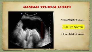 MAXIMAL VERTICAL POCKETMAXIMAL VERTICAL POCKET
<< 2 cm : Oligohydramnios 2 cm : Oligohydramnios
> 8 cm : Polyhydramnios> 8 cm : Polyhydramnios 
2-8 Cm Normal
 