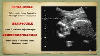 MENINgoCELEMENINgoCELE
  When it contains only meningesWhen it contains only meninges
MENINgoENCEPHALoCELEMENINgoENCEPHALoCELE
Brain tissue is included in theBrain tissue is included in the
herniated tissue.herniated tissue.
CEPHALoCELE
Intracranial tissue herniates
Through a defect in cranium
 