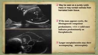  May be seen as a purely cysticMay be seen as a purely cystic
mass or may contain echoes frommass or may contain echoes from
herniated brain tissue.herniated brain tissue. 
 If the mass appears cystic, theIf the mass appears cystic, the
Meningoecele componentMeningoecele component
predominatespredominates, while a solid masssolid mass
indicates predominantly anindicates predominantly an
EncephaloceleEncephalocele. 
 Larger encephalocoeles may showLarger encephalocoeles may show
accompanying  microcephaly.accompanying  microcephaly.
 
