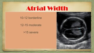 Atrial Width
 Most useful and accepted
 Must be taken on true axial view
 Measured at widest part of ventricles
 Inner to inner vent walls
10-12 borderline
12-15 moderate
>15 severe
 