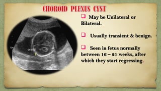  May be Unilateral orMay be Unilateral or
Bilateral.Bilateral.
 Usually transient & benign.Usually transient & benign.
 Seen in fetus normallySeen in fetus normally
between 16 – 21 weeks, afterbetween 16 – 21 weeks, after
which they start regressingwhich they start regressing..
 