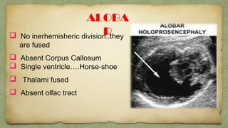  No inerhemisheric division..they
are fused
 Absent Corpus Callosum
 Single ventricle….Horse-shoe
 Thalami fused
 Absent olfac tract
ALOBA
R
 