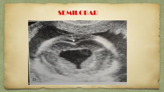 SEMILOBAR
 Incomp interhemsph division…
Fused ant.
 Rudimentary cerbral lobes
 Partial/complele Fusion of Thallamus
 