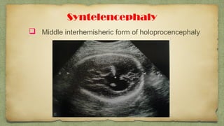 Syntelencephaly
 Middle interhemisheric form of holoprocencephaly
 