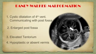 DANDY-WALKER MALFORMATION
1. Cystic dilatation of 4th
vent.
Communicating with post fossa
2. Enlarged post fossa
3. Elevated Tentorium
4. Hypoplastic or absent vermis
 