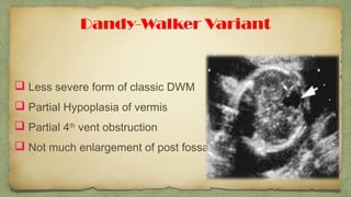 Dandy-Walker Variant
 Less severe form of classic DWM
 Partial Hypoplasia of vermis
 Partial 4th
vent obstruction
 Not much enlargement of post fossa
 