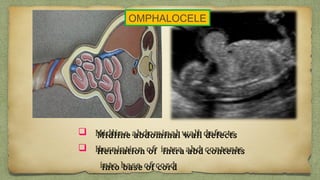  Midline abdominal wall defectsMidline abdominal wall defects
 Herniation of intra abd contentsHerniation of intra abd contents
into base of cordinto base of cord
OMPHALOCELE
 