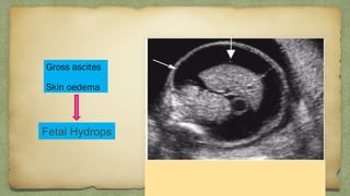 Gross ascites
Skin oedema
Fetal Hydrops
 