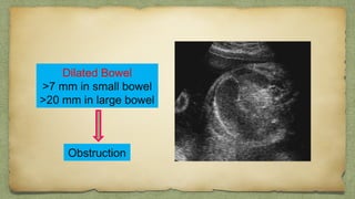 Dilated Bowel
>7 mm in small bowel
>20 mm in large bowel
Obstruction
 