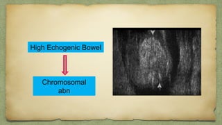 High Echogenic Bowel
Chromosomal
abn
 