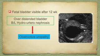  Fetal bladder visible after 12 wk
Over distended bladder
B/L Hydro-urtero nephrosis
Obstructive uropathy
 