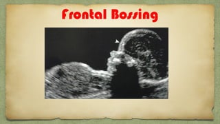 Frontal Bossing
 