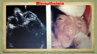 Micropthalmia
 