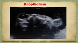 Anopthalmia
 